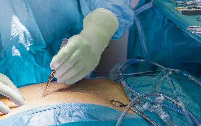 Surgeon with double gloving surgical gloves cutting in stommach